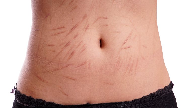 Las autolesiones son más comunes en chicas, las hacen en privado y suelen taparlas